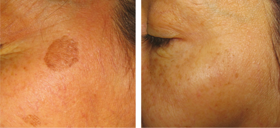 Images provided by PicoWay supplier