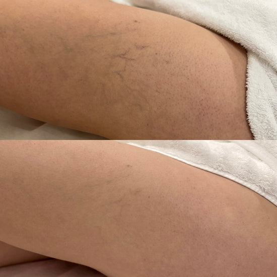 After 1 treatment
