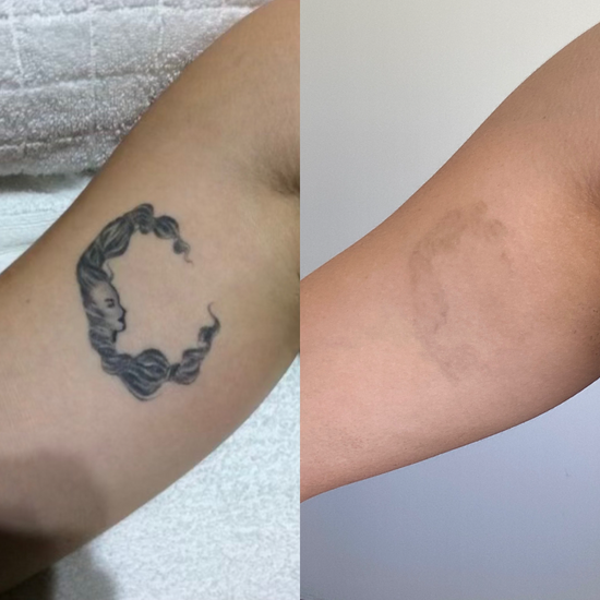 Post 5 PicoWay treatments.