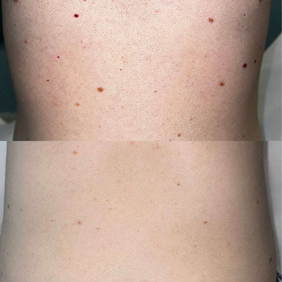 After 3 treatments