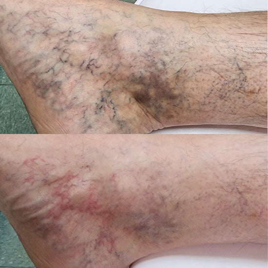 After 1 treatment