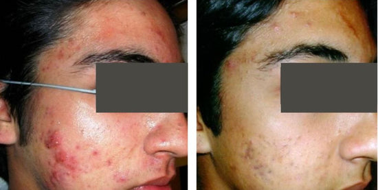 Images provided by PicoWay supplier