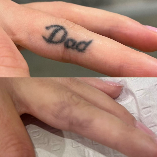 Post 3 PicoWay treatments.