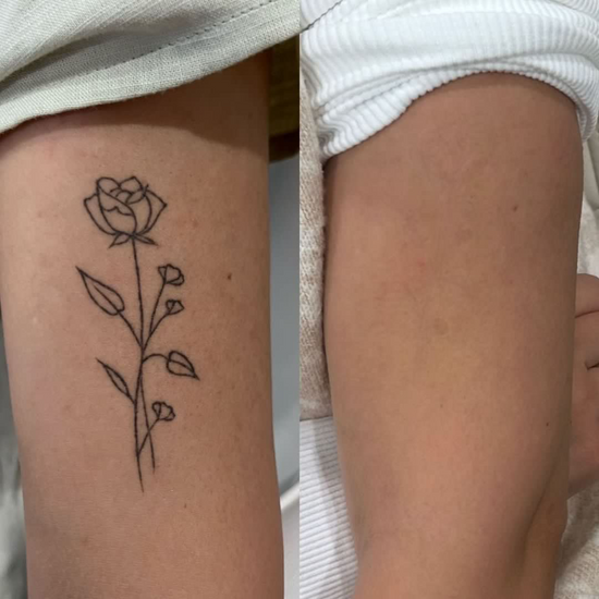 Tattoo Removal